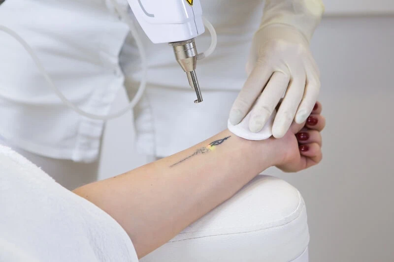 Laser Tattoo Removal