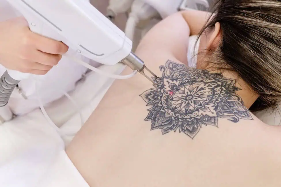Tattoo Removal by The Vitality & Aesthetics Institute in Houston, TX